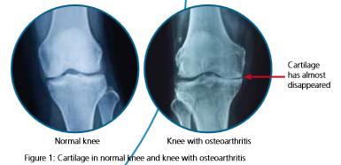 Normal Knee comparison