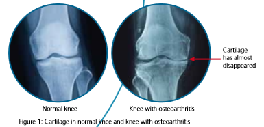 Knee comparison