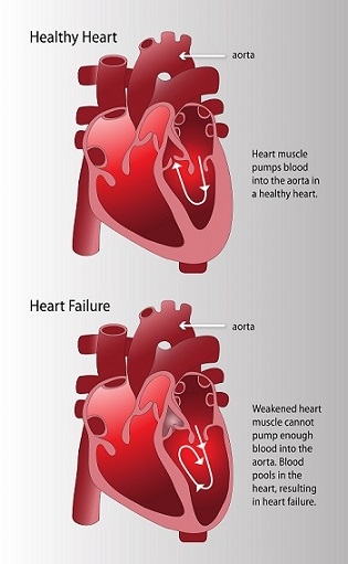 healthy heart vs heart disease